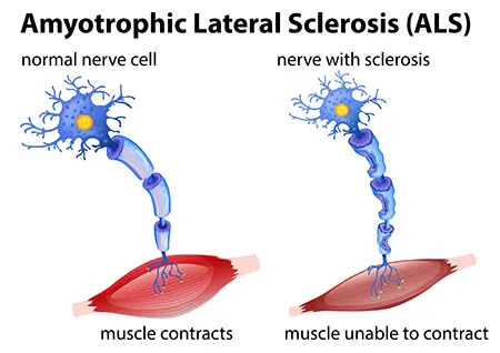 concetto di sclerosi laterale amiotrofica