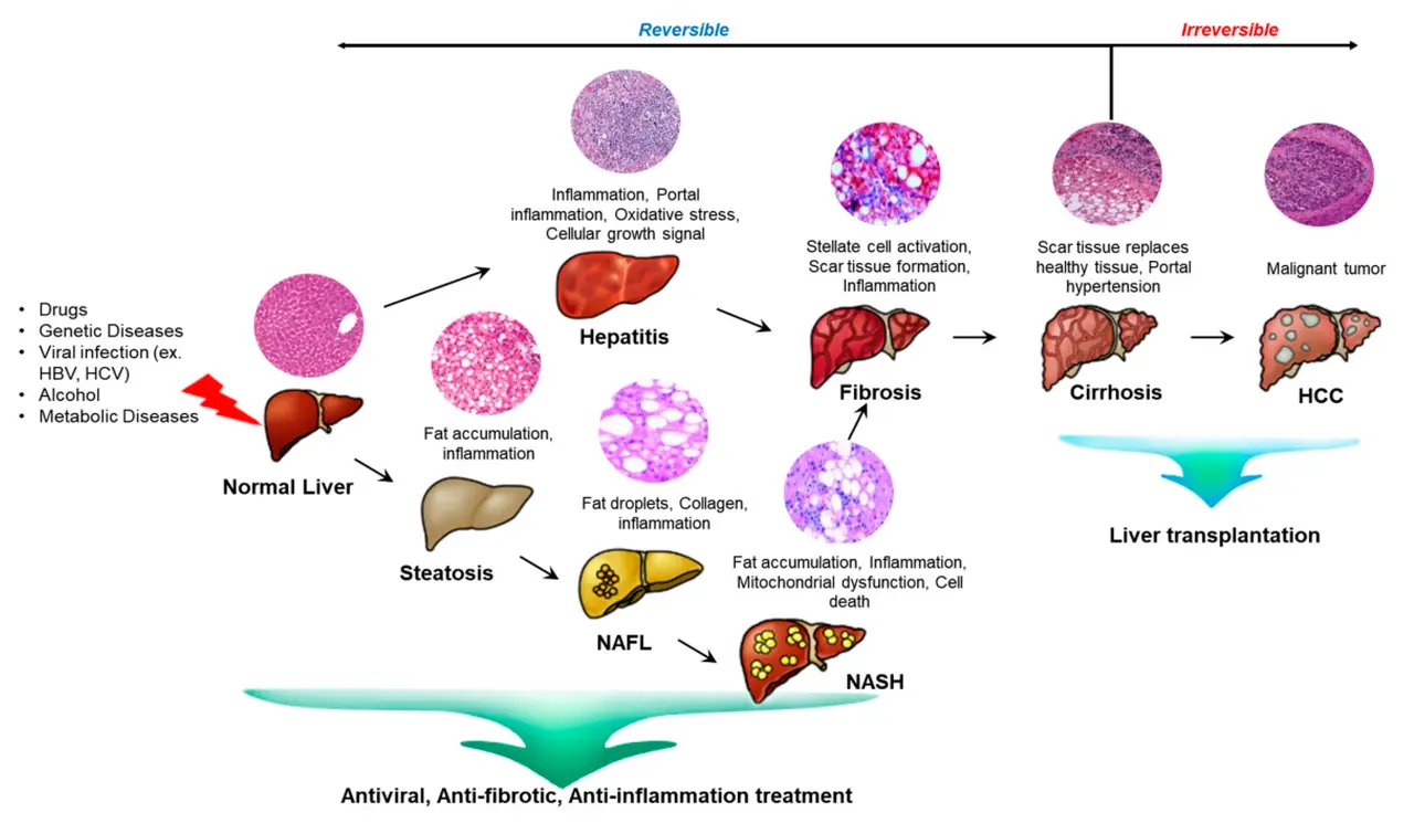 Un'infografica che illustra come funziona il trattamento con cellule staminali nelle malattie epatiche