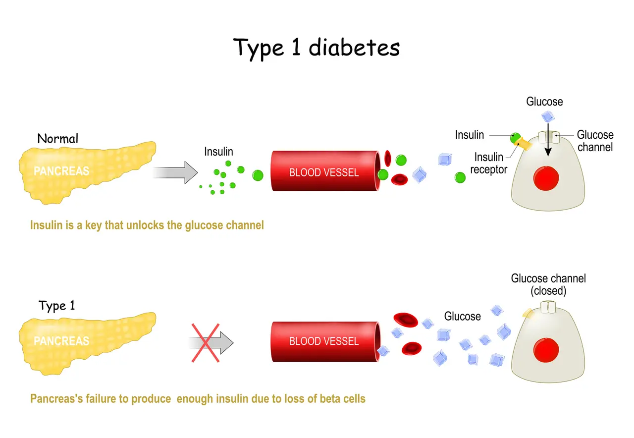 Tipi di diabete mellito.