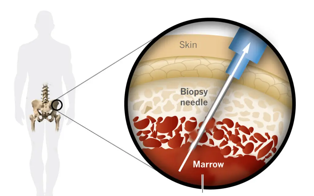 Illustrazione grafica del prelievo di cellule staminali dal midollo osseo 