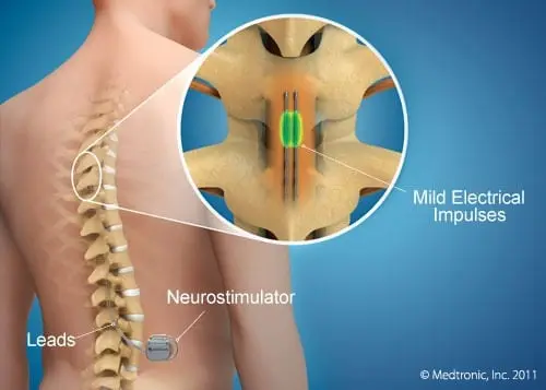 Stimolazione epidurale