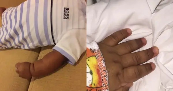 trattamento con cellule staminali per bambini