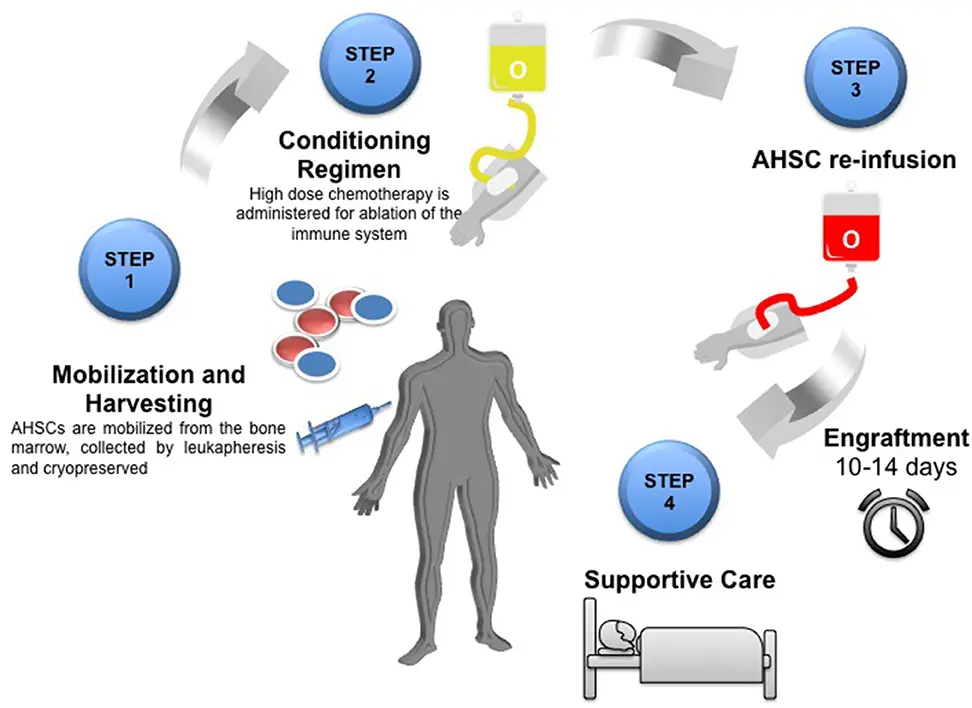 Una rappresentazione grafica del trapianto di cellule staminali in un paziente con sclerosi multipla