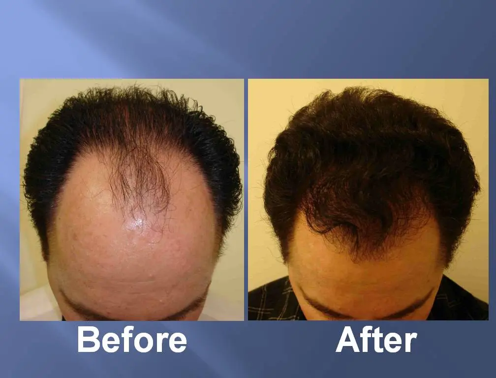 Immagini prima e dopo del ripristino dei capelli mediante terapia con cellule staminali
