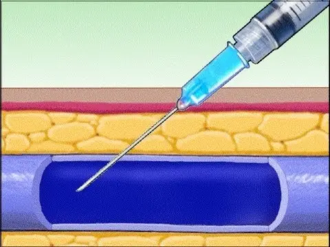 Iniezione endovenosa