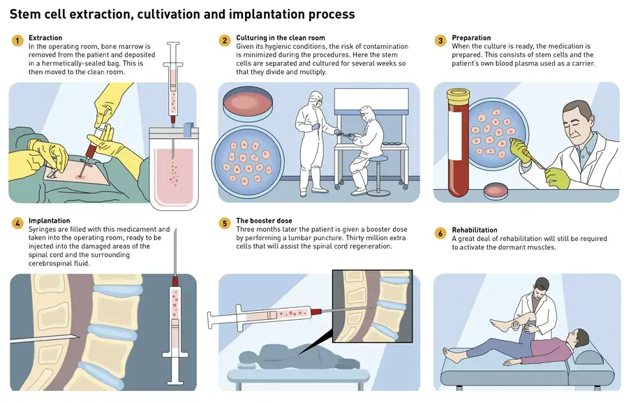 processo del trattamento con cellule staminali per le lesioni al ginocchio